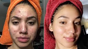 How To Transform Skin after Years of Acne and Scarring